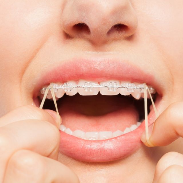 Why You Might Need Rubber Bands with Houston Braces