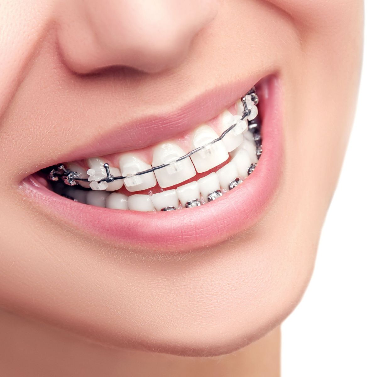Houston ceramic braces